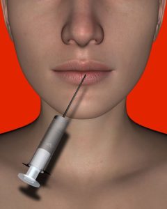 lip fillers